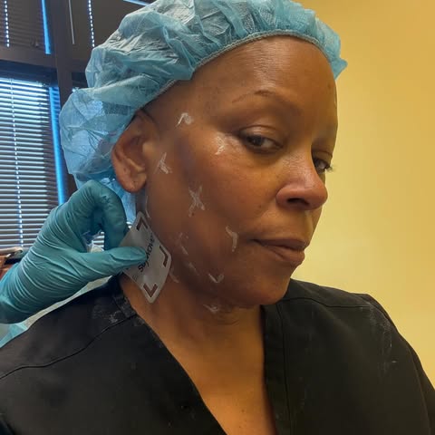 What is Sofwave?
 
Sofwave is a non-invasive ultrasound treatment that stimulates collagen to lift a