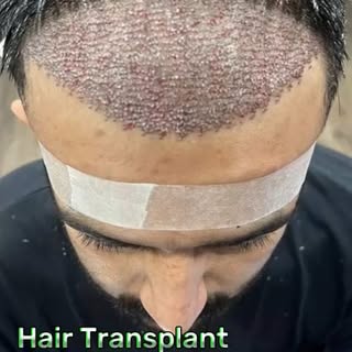 One decision can change everything.

A hair transplant is a one-time procedure that delivers permane