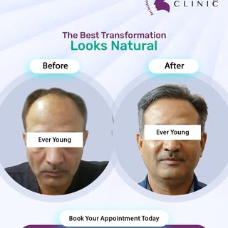 Before ➡️ After

 From bald patches to fuller hair! 

 See the difference with FUE Transplant.
 ✔ Na