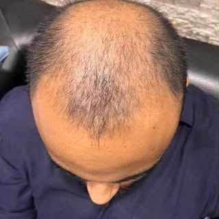 Hair loss no longer has to be a lifelong reality.

Advanced treatments today are restoring hair—and 