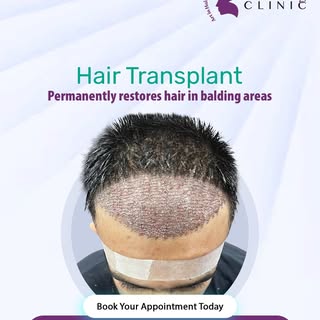 Balding areas can be restored permanently!

A hair transplant restores natural, growing hair exactly