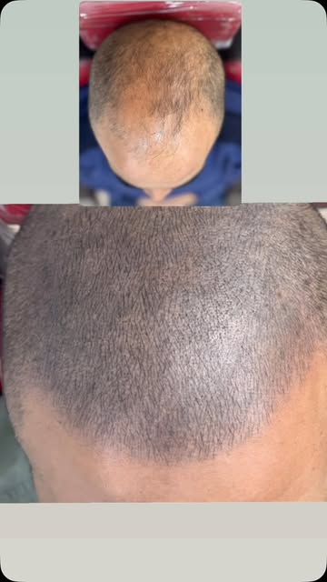Micropigmentación capilar #córdoba #argentina🇦🇷