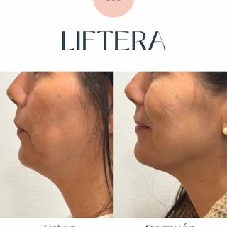 Este es el espectacular resultado que conseguimos con Liftera: reducción de papada, mandíbula más ma