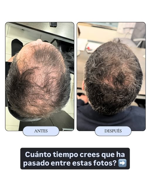 Cuando vino a consulta teníamos tres objetivos: frenar la caída, recuperar densidad y mejorar la cal