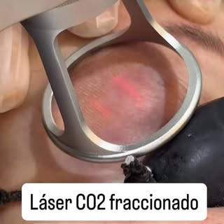 Pero… ¿qué hace exactamente, y por qué da resultados tan potentes? 👇

El láser CO2 fraccionado es u