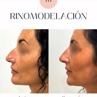 👃💉¿Se puede cambiar la forma de la nariz sin cirugía? 

La rinomodelación con ácido hialurónico es