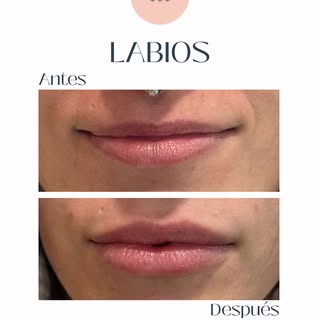 Antes y después👄✨ Ácido hialurónico en labios: hidratación + aumento de volumen sutil, manteniendo 