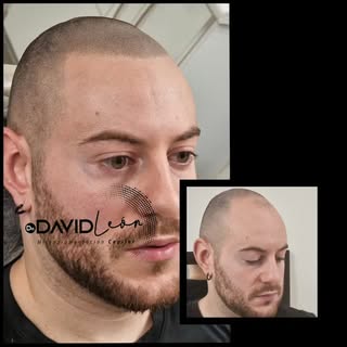 Cambiamos tu imagen para que recuperes tu marco frontal. Di adiós al aspecto que te da la alopecia a
