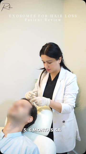 Do exosomes actually work for hair loss? 👀

Instead of us telling you, hear it directly from a pati