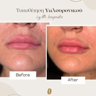 Φυσικός όγκος, καλύτερο σχήμα και πιο ενυδατωμένη όψη στα χείλη.

Η τοποθέτηση υαλουρονικού γίνεται 