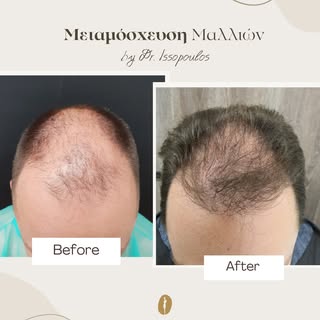 Μεταμόσχευση μαλλιών με φυσικό αποτέλεσμα, σχεδιασμένη πάνω στις ανάγκες κάθε ασθενή.

Στo Surgical 