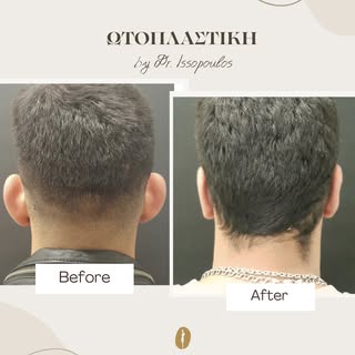 Φυσικό αποτέλεσμα με σωστό σχεδιασμό και απόλυτη προσοχή στη λεπτομέρεια.

Η ωτοπλαστική διορθώνει τ