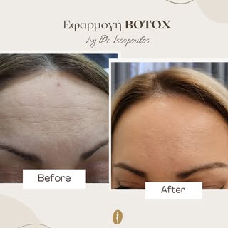 Λείο και ξεκούραστο αποτέλεσμα, χωρίς να χάνεται η φυσική έκφραση του προσώπου.

Η εφαρμογή botox συ