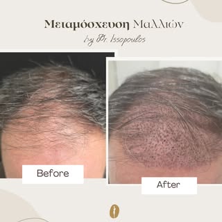 Σχεδιασμός με ακρίβεια, φυσική πυκνότητα και αποτέλεσμα που εξελίσσεται σταδιακά.

Η μεταμόσχευση μα