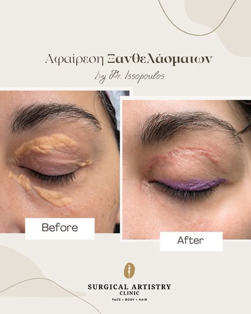 Η αφαίρεση ξανθελασμάτων μπορεί να βελτιώσει αισθητά την όψη της περιοχής γύρω από τα μάτια, χαρίζον