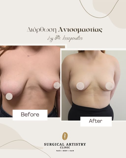 Η ανόρθωση μαστού στοχεύει στην αποκατάσταση της θέσης και του σχήματος του στήθους, προσφέροντας πι