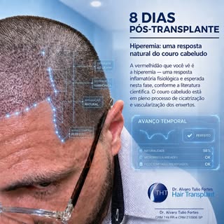 Voce sabe o que te espera após o transplante capilar?

Só alegrias !