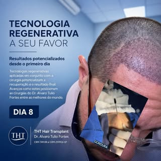 Terapias Regeneraticas no Transplante Capilar.
Somos pioneiros no processo.

Já consolidado nos maio