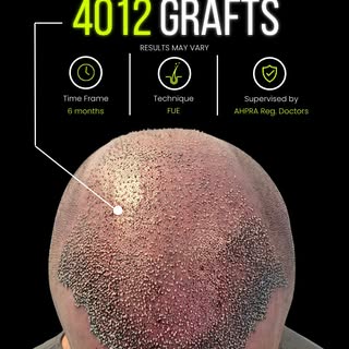 𝗛𝗮𝗶𝗿 𝗧𝗿𝗮𝗻𝘀𝗽𝗹𝗮𝗻𝘁 | 𝗖𝗹𝗶𝗻𝗶𝗰𝗮𝗹 𝗖𝗮𝘀𝗲 𝗦𝘂𝗺𝗺𝗮𝗿𝘆

A patient presenting with 