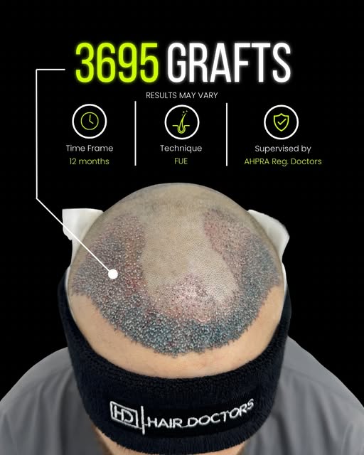 𝗛𝗮𝗶𝗿 𝗧𝗿𝗮𝗻𝘀𝗽𝗹𝗮𝗻𝘁 | 𝗖𝗹𝗶𝗻𝗶𝗰𝗮𝗹 𝗖𝗮𝘀𝗲 𝗦𝘂𝗺𝗺𝗮𝗿𝘆

A patient presenting with 