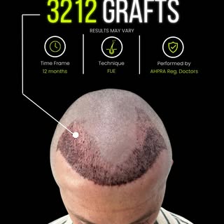 𝗛𝗮𝗶𝗿 𝗧𝗿𝗮𝗻𝘀𝗽𝗹𝗮𝗻𝘁 | 𝗖𝗹𝗶𝗻𝗶𝗰𝗮𝗹 𝗖𝗮𝘀𝗲 𝗦𝘂𝗺𝗺𝗮𝗿𝘆

A patient presenting with 