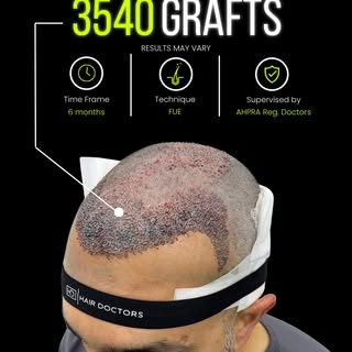 𝗛𝗮𝗶𝗿 𝗧𝗿𝗮𝗻𝘀𝗽𝗹𝗮𝗻𝘁 | 𝗖𝗹𝗶𝗻𝗶𝗰𝗮𝗹 𝗖𝗮𝘀𝗲 𝗦𝘂𝗺𝗺𝗮𝗿𝘆

A patient presenting with 