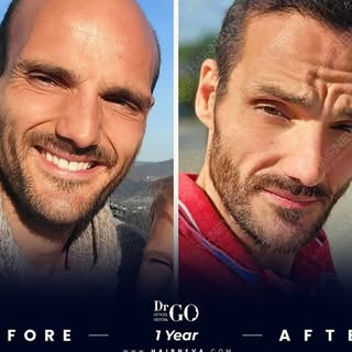 ✨ We had performed hair transplant operation with DHI Technique to our patient 1 year ago. 🦁 Here i