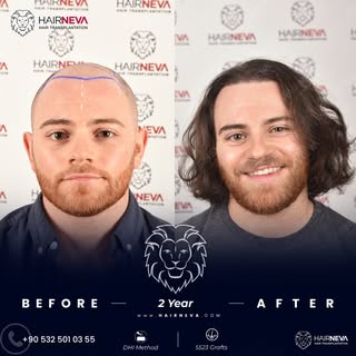 ✨ We performed a hair transplant operation using the DHI Technique for our patient 2 year ago. 🦁

H