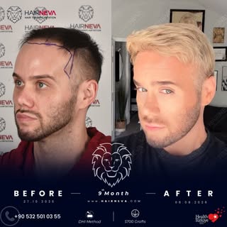 We performed a DHI hair transplant for our patient 9 months. 🦁⁠
⁠
A look at the transformation: fro