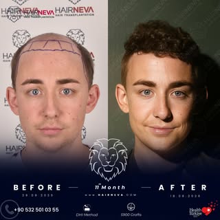 We performed a DHI hair transplant for our patient 11 months. 🦁⁠
⁠
A look at the transformation: fr