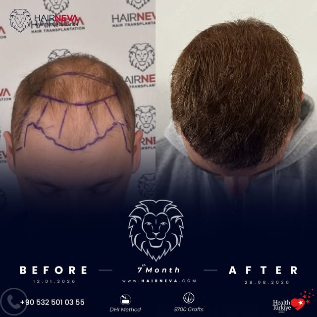 We performed a DHI hair transplant for our patient 7 months. 🦁⁠
⁠
A look at the transformation: fro