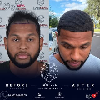We performed a DHI hair transplant for our patient 8 months. 🦁⁠
⁠
A look at the transformation: fro