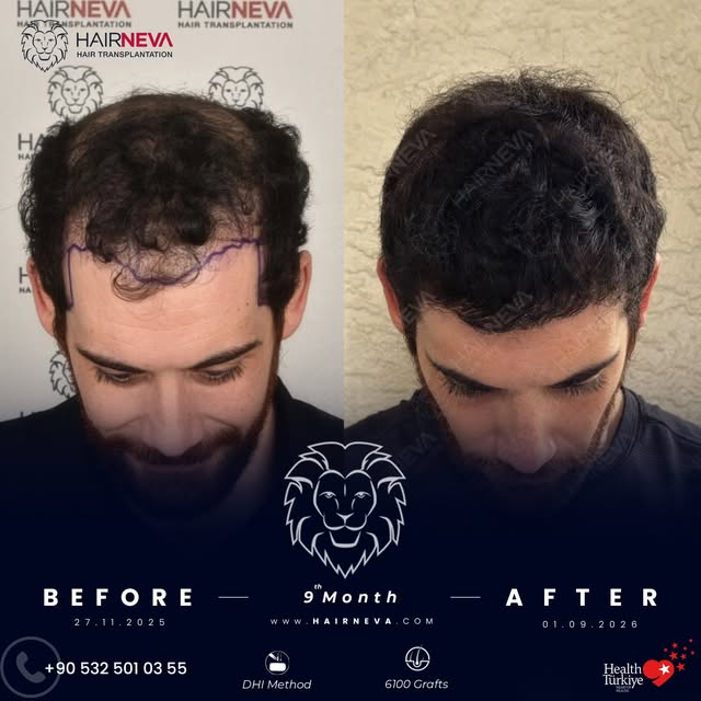 We performed a DHI hair transplant for our patient 9 months. 🦁⁠
⁠
A look at the transformation: fro