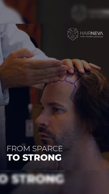 From the First Step 🦁

Our patient shares his HairNeva journey from the very beginning, including w
