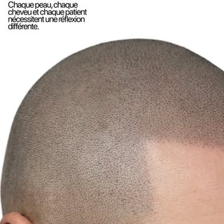 La micropigmentation capillaire ne consiste pas simplement à reproduire des milliers de points.

Cha
