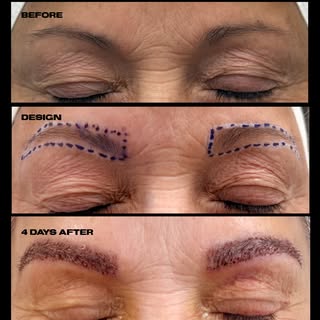 Have you ever heard of an eyebrow transplant? I draw your desired brow shape and then take hair foll