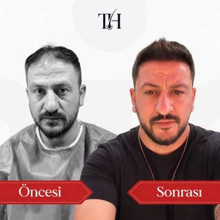 Değişim sadece saçla değil, özgüvenle başlar. ✨

Doğal saç çizgisi ve kişiye özel planlama ile sonuç
