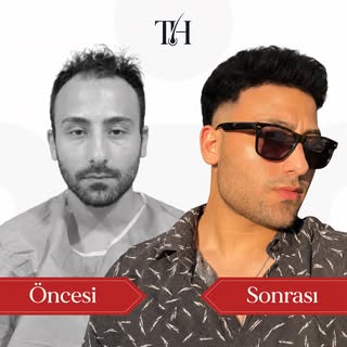 Yeni saç, yeni ifade, daha güçlü görünüm. 🔥

Saç ekiminde doğru planlama farkı ilk bakışta belli ed