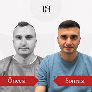 Gerçek sonuç, gerçek dönüşüm 🔥
Saç ekiminde doğru dokunuşlarla doğal ve güçlü bir görünüm mümkün.
Ö
