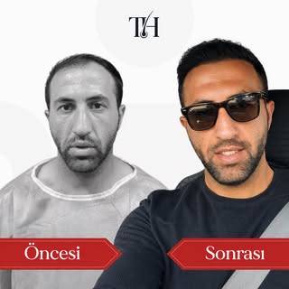 Öncesi ve sonrası arasındaki farkı siz de görüyor musunuz? 👀
Doğru planlama, doğal saç çizgisi ve k
