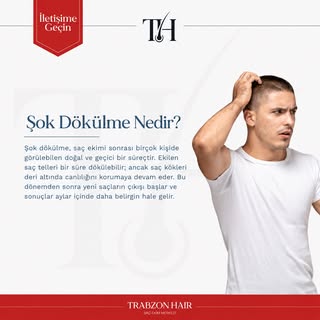 Saç ekimi sonrası şok dökülme sizi korkutmasın 👇
Şok dökülme, saç ekimi sonrası oldukça sık görülen