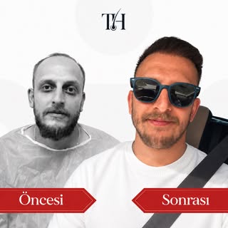 Değişim gözle görülür, sonuç özgüven verir. ✨
Saç ekimiyle doğal ve güçlü bir görünüm mümkün.

📩 Sa
