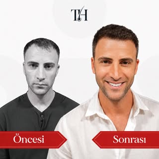 Öncesi ve sonrası arasındaki fark özgüveni de değiştirir. ✨
Doğal görünüm, doğru planlama ve başarıl