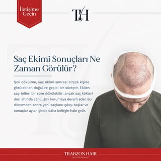 Saç ekimi sonuçları hemen değil, doğru süreçle zamanla görünür. ⏳
Sabır, doğru bakım ve düzenli taki