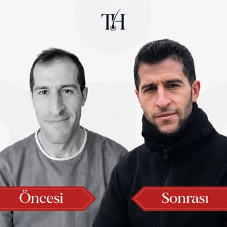 Doğal ve güçlü bir görünüm, doğru saç çizgisi planlamasıyla başlar. ✨
Saç ekimi sürecinde kişiye öze
