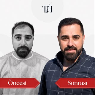 Saç ekimi, sadece saç yoğunluğunu değil kişinin kendini daha iyi hissetmesini de destekler. ✅
Doğru 