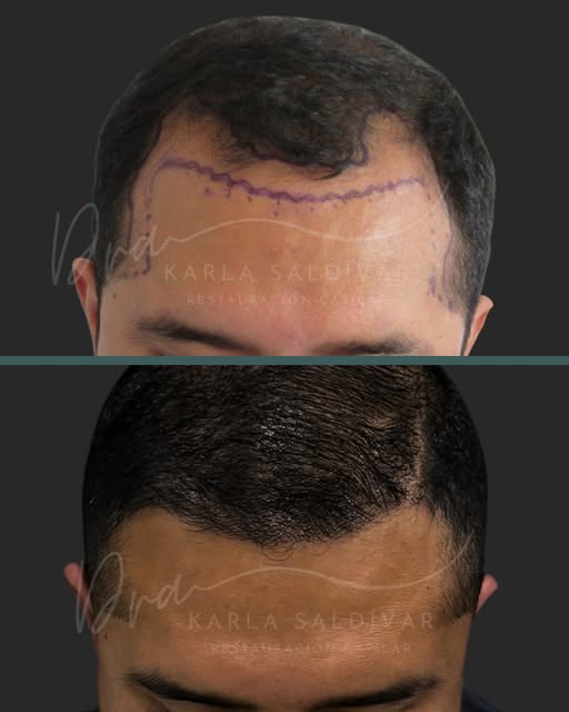 Una línea frontal bien diseñada no cambia tu identidad: recupera proporción, enmarca el rostro y dev