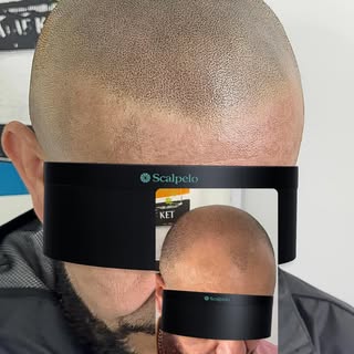 Micropigmentación capilar de alto nivel.
Resultados naturales, personalizados y realistas.

📍 Scalp