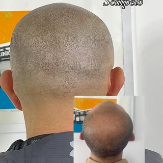 Resultado 100% natural.
Micropigmentación capilar diseñada para verse real, discreta e imperceptible