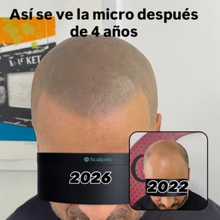 Así se ve una micropigmentación bien hecha con el paso del tiempo.

2022 ➝ 2026
Sin virajes de color